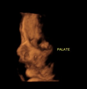 this 3 d cut view shows the cleft lip and an intact palate