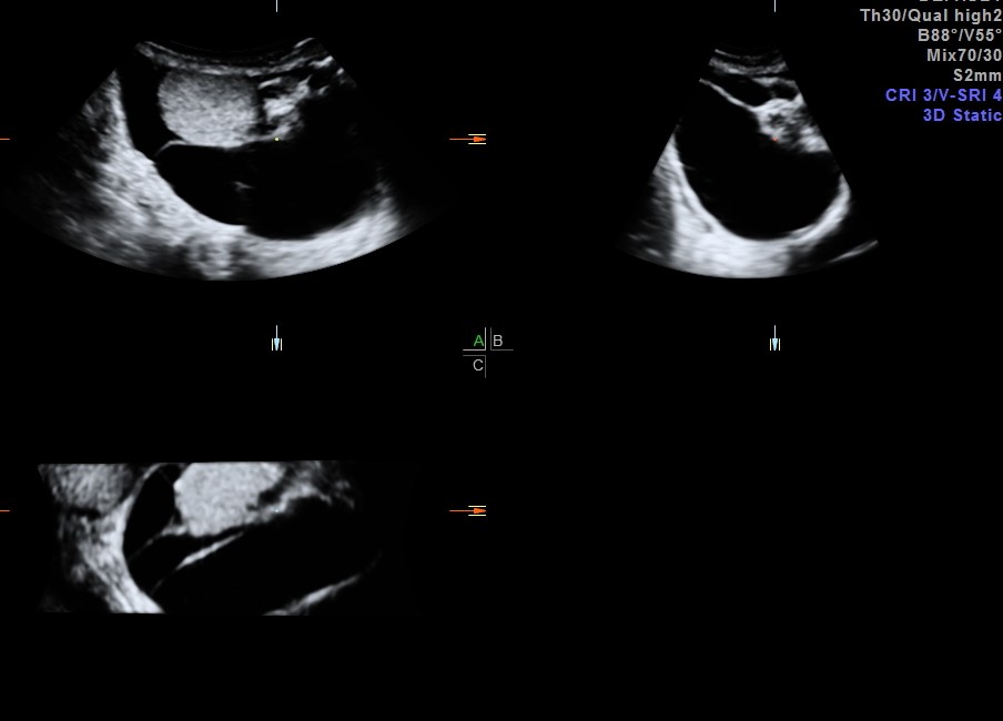 MULTI PLANAR VIEW OF SEPTATED HYDROCELE