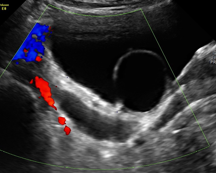 the dilated distal ureter is seen .Colour doppler shows flow in the adjacent vessels