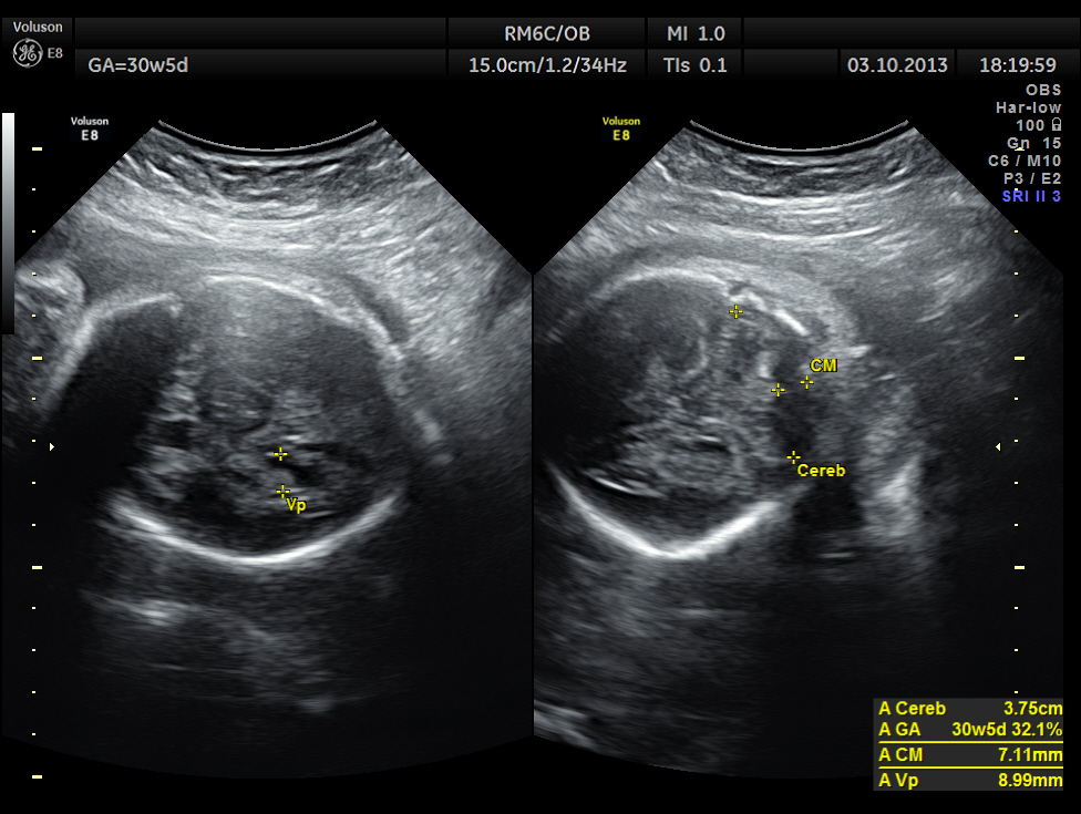 photo of 13 week fetus