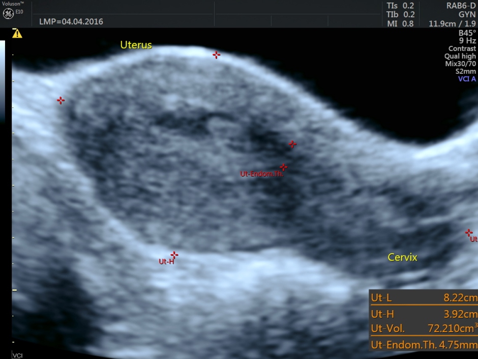 vascular malformation in uterus_9